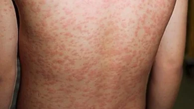 Em qual cidade foram registrados casos de sarampo no Brasil?