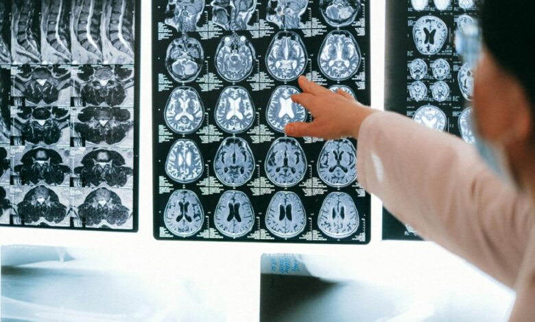 Nova técnica brasileira pode diagnosticar Alzheimer com simples teste