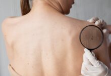 Os fatores que promovem o surgimento de verrugas e como preveni-las