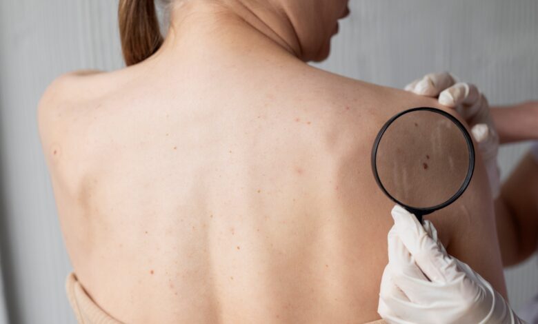 Os fatores que promovem o surgimento de verrugas e como preveni-las