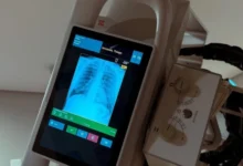 O que é a hérnia de disco cervical?