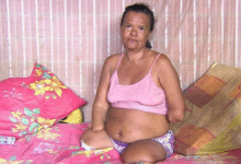 Após Ter Mãos E Pernas Amputad4s, Mulher Acaba Sendo... Ver Mais