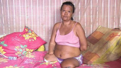 Após Ter Mãos E Pernas Amputad4s, Mulher Acaba Sendo... Ver Mais