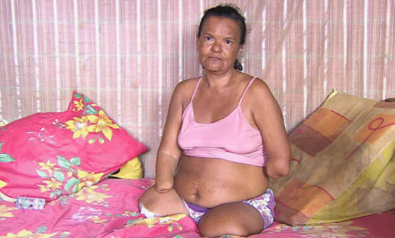 Após Ter Mãos E Pernas Amputad4s, Mulher Acaba Sendo... Ver Mais