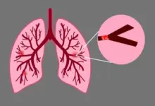 Embolia pulmonar: conheça os sintomas e os fatores de risco da doença