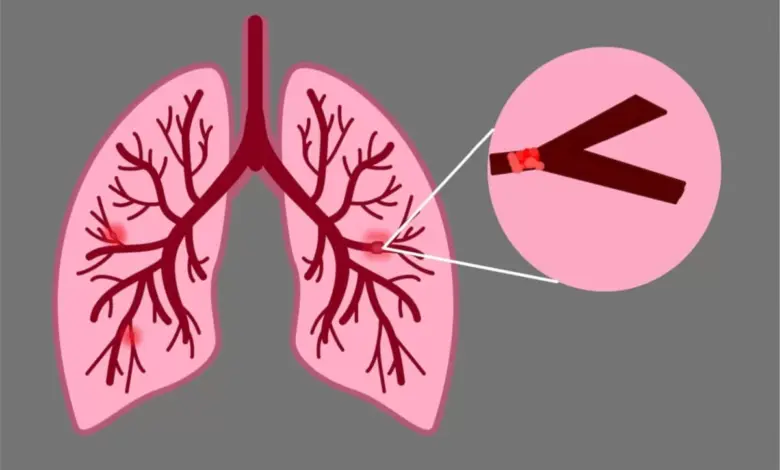 Embolia pulmonar: conheça os sintomas e os fatores de risco da doença