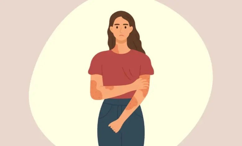 Psoríase: conheça os sintomas da doença e fatores que podem desencadear crises