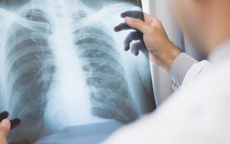 Emrelis traz esperança para pacientes com câncer de pulmão metastático