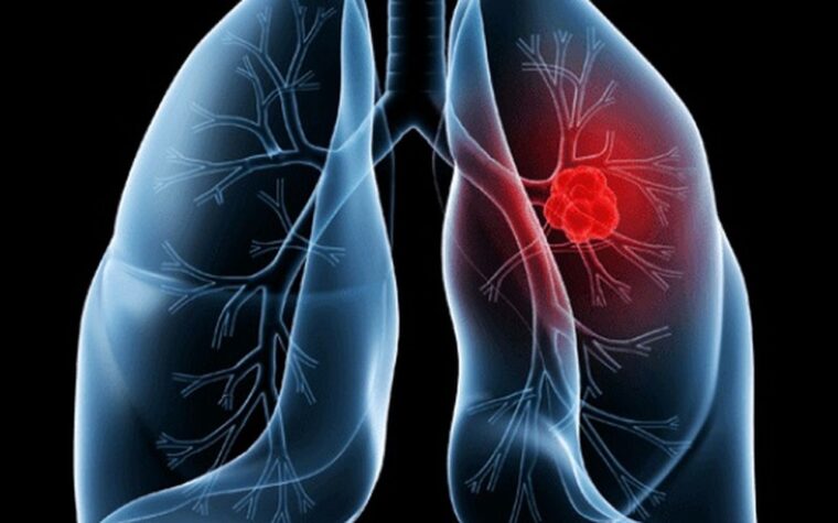 Adenocarcinoma pulmonar é câncer que afeta o pulmão masculino